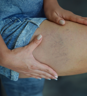 Leg Spider Vein Treatment