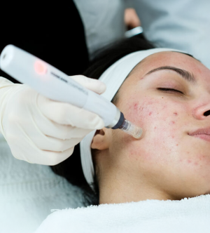 Microneedling for Acne Scars