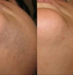 Laser hair removal in Toronto before and after treatment information.