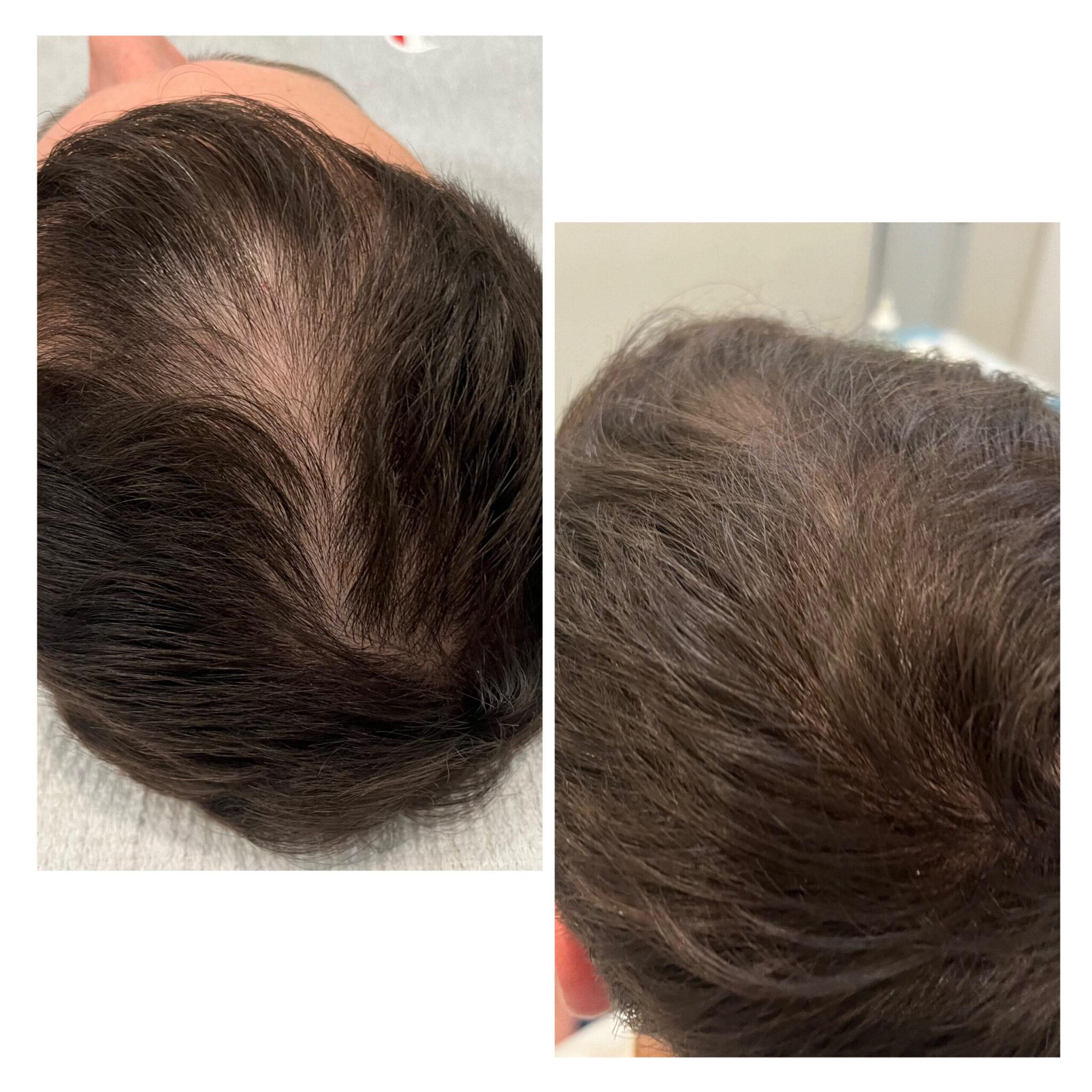 What Is PRP For Skin & Hair Restoration?