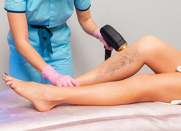 Spider Vein Removal